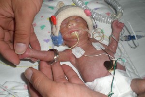 CHOC Small Baby Unit patient, Emma Faith, who weighed only 1 pound 4 ounces at birth. 