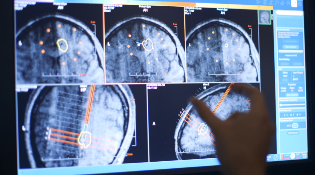 MRIGuided Laser Ablation with Stereotactic Assistance Targets Epilepsy
