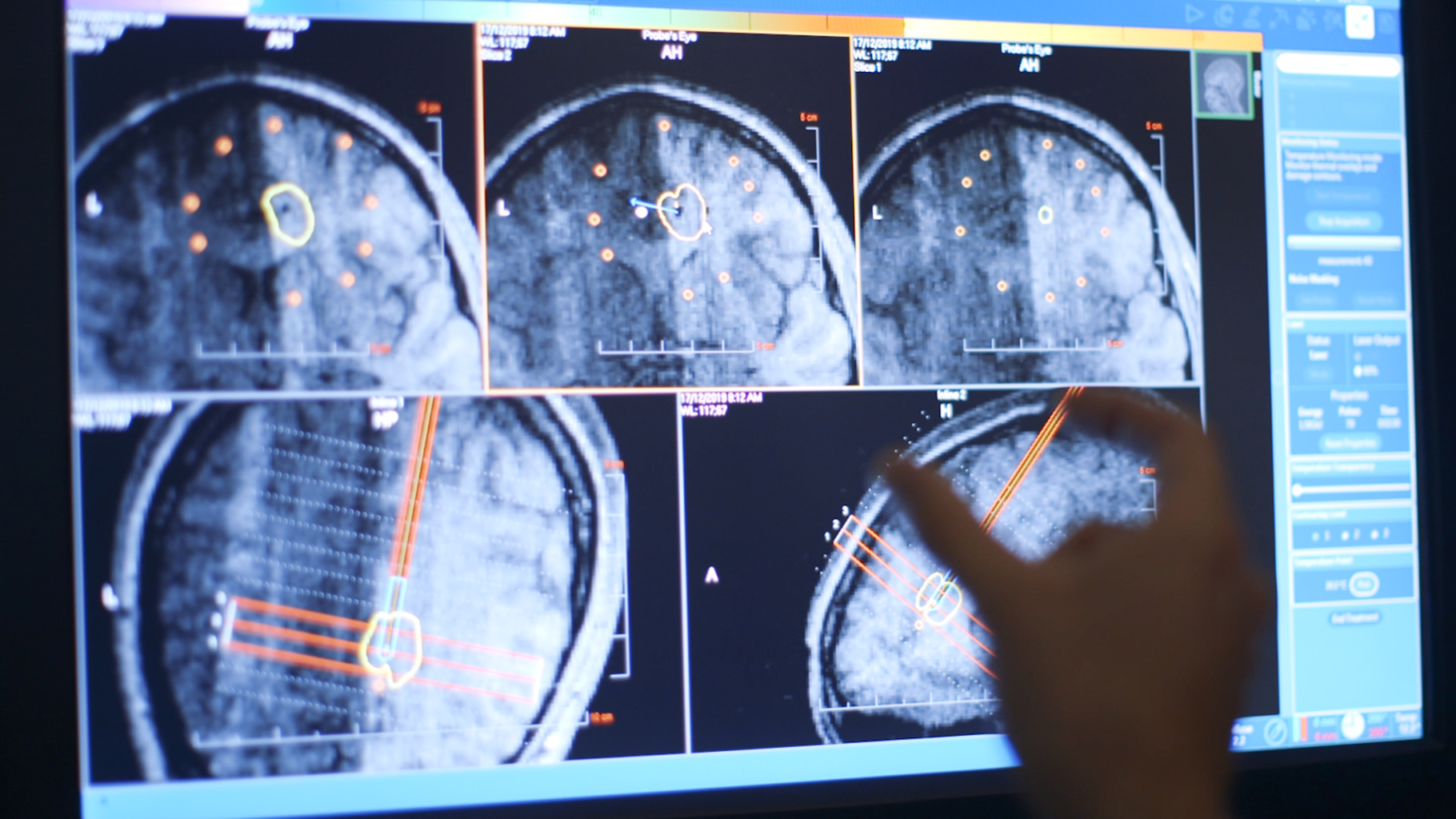 neurolaserablation3 CHOC Docs Blog